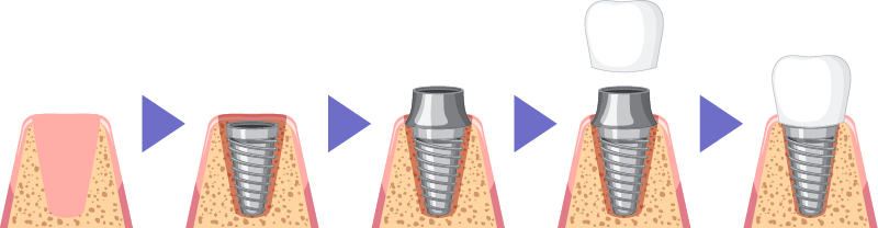 インプラント治療工程