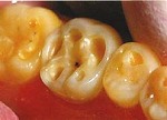 むし歯・歯周病に次ぐ第三の疾患　酸蝕症